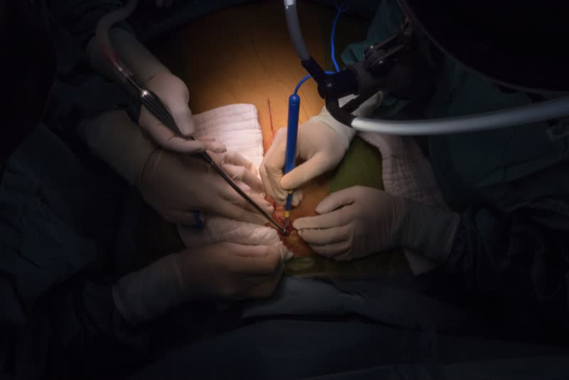 Foto di un'equipe medica di cardio chirurghi impegnata a svolgere una sternotomia per applicare un cuore artificiale su un paziente